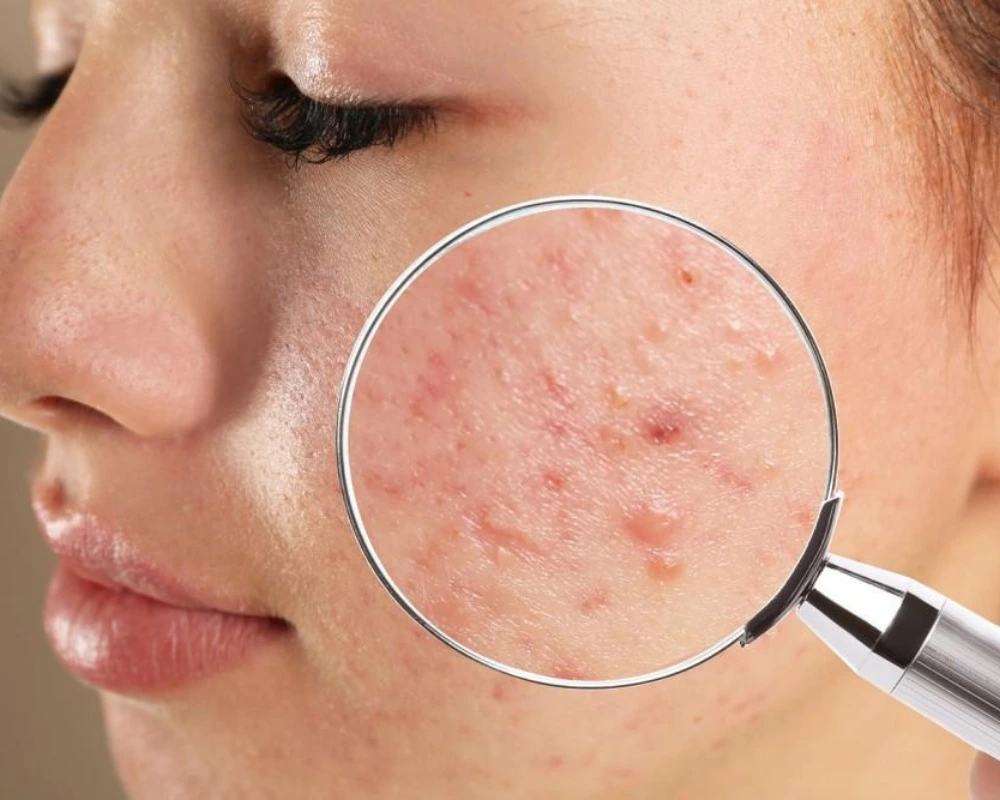 acne post