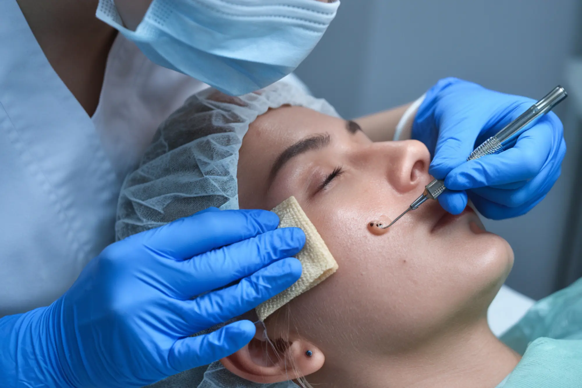 dermato surgery